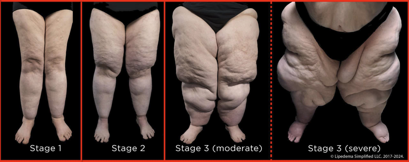 The three stages of lipedema — Stage 1, Stage 2, Stage 3 moderate, Stage 3 severe.