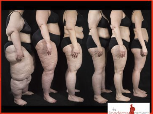 Side profile progression of lipedema across multiple body types and stages.