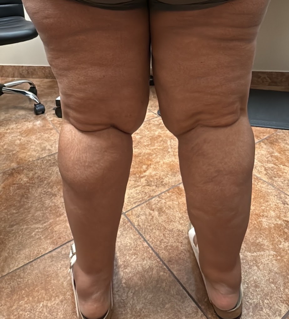 Clinical photo, posterior view of legs showing nodular lipedema tissue and fat deposits behind the knees.