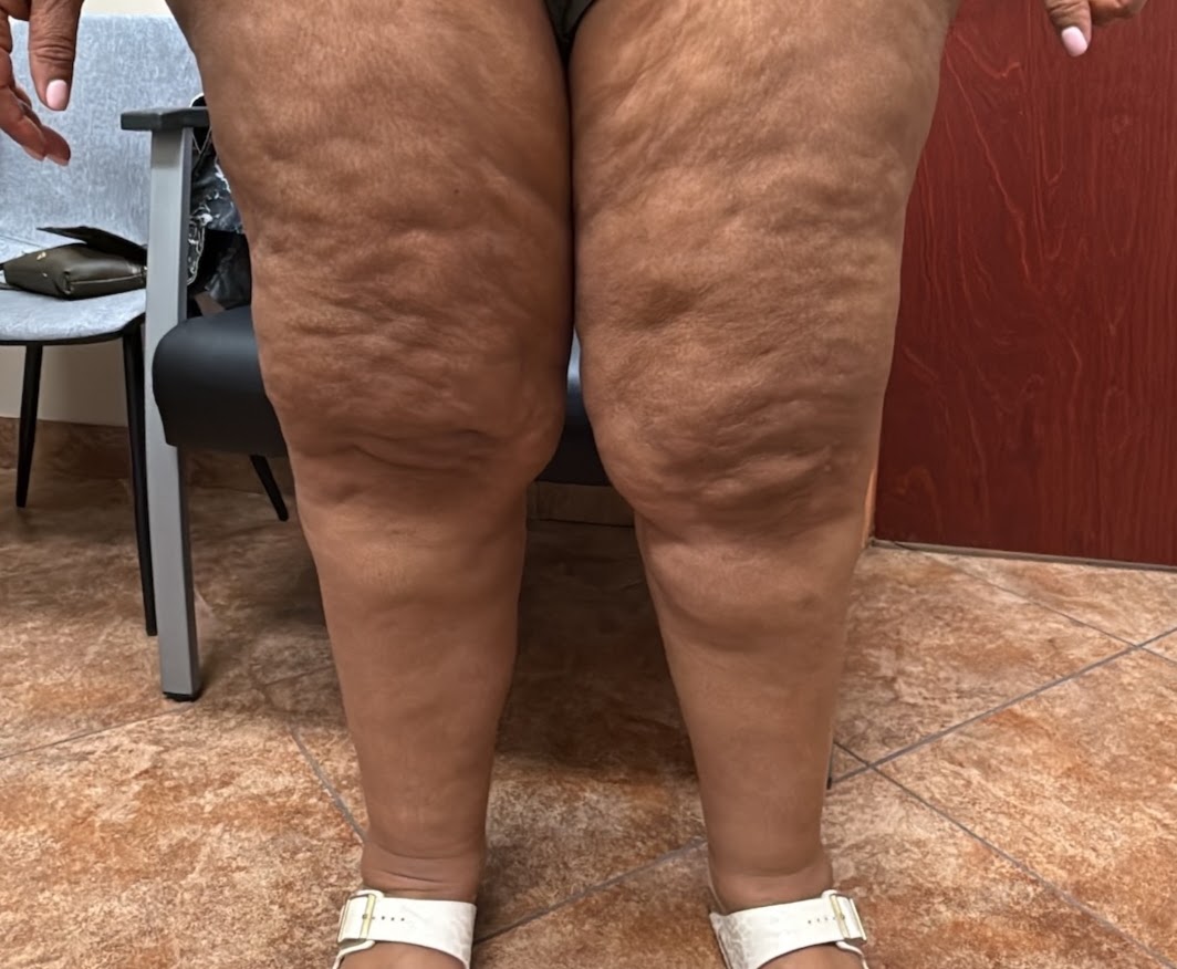 Clinical photo, anterior view of legs showing nodular lipedema tissue.